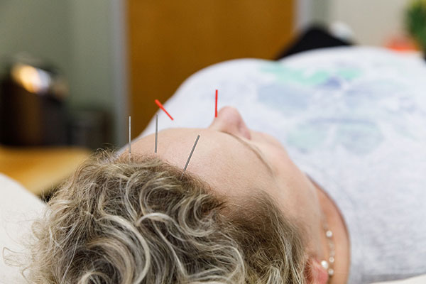 Acid Reflux & Acupuncture